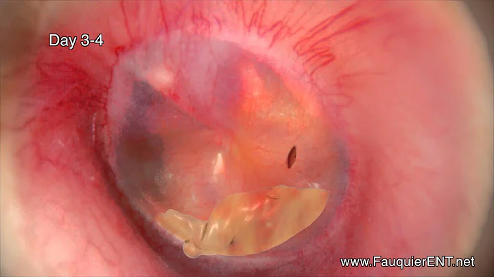 EAR INFECTION With DRAINAGE Time Lapse Video