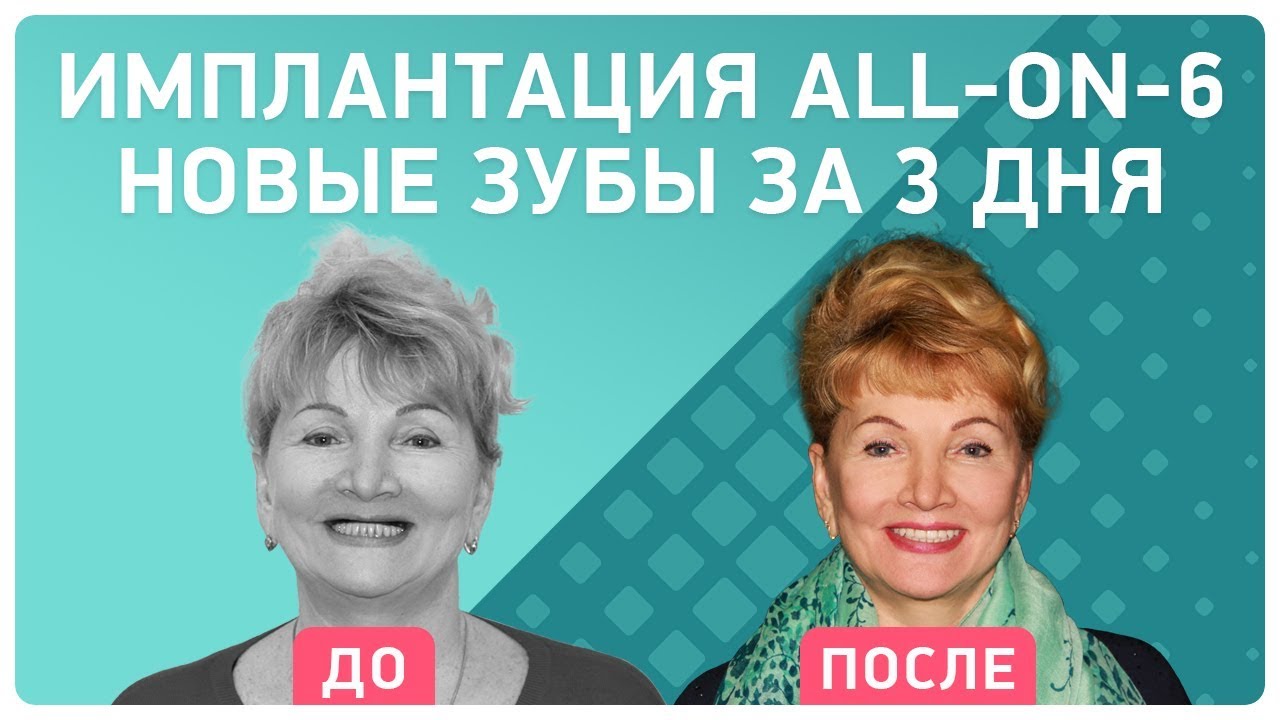 Одноэтапная имплантация. Отзыв о восстановлении всех зубов за 3 дня в клинике Smile-at-Once
