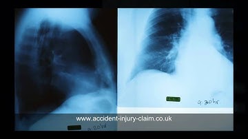 Workers Compensation Guidelines video