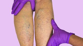 How unsightly spider veins are removed (Sclerotherapy) by Understand 630 views 1 month ago 4 minutes, 50 seconds