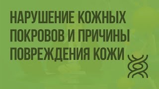 Нарушение кожных покровов и причины повреждения кожи. Видеоурок по биологии 8 класс