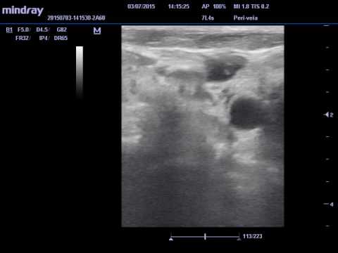 Vídeo: Trombose Da Veia Jugular Interna - Sintomas E Tratamento