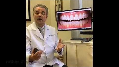 No porcelain veneers, Bioclear veneers save money and tooth structure