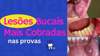 Lesões Bucais Mais Cobradas Em Prova Resumos De Odonto