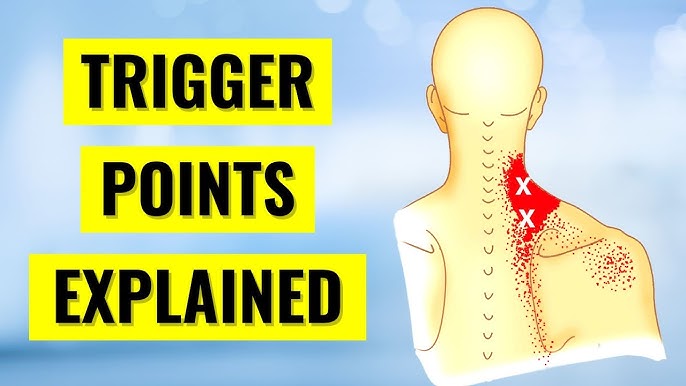 Myofascial Pain Trigger Point Injections Explained 