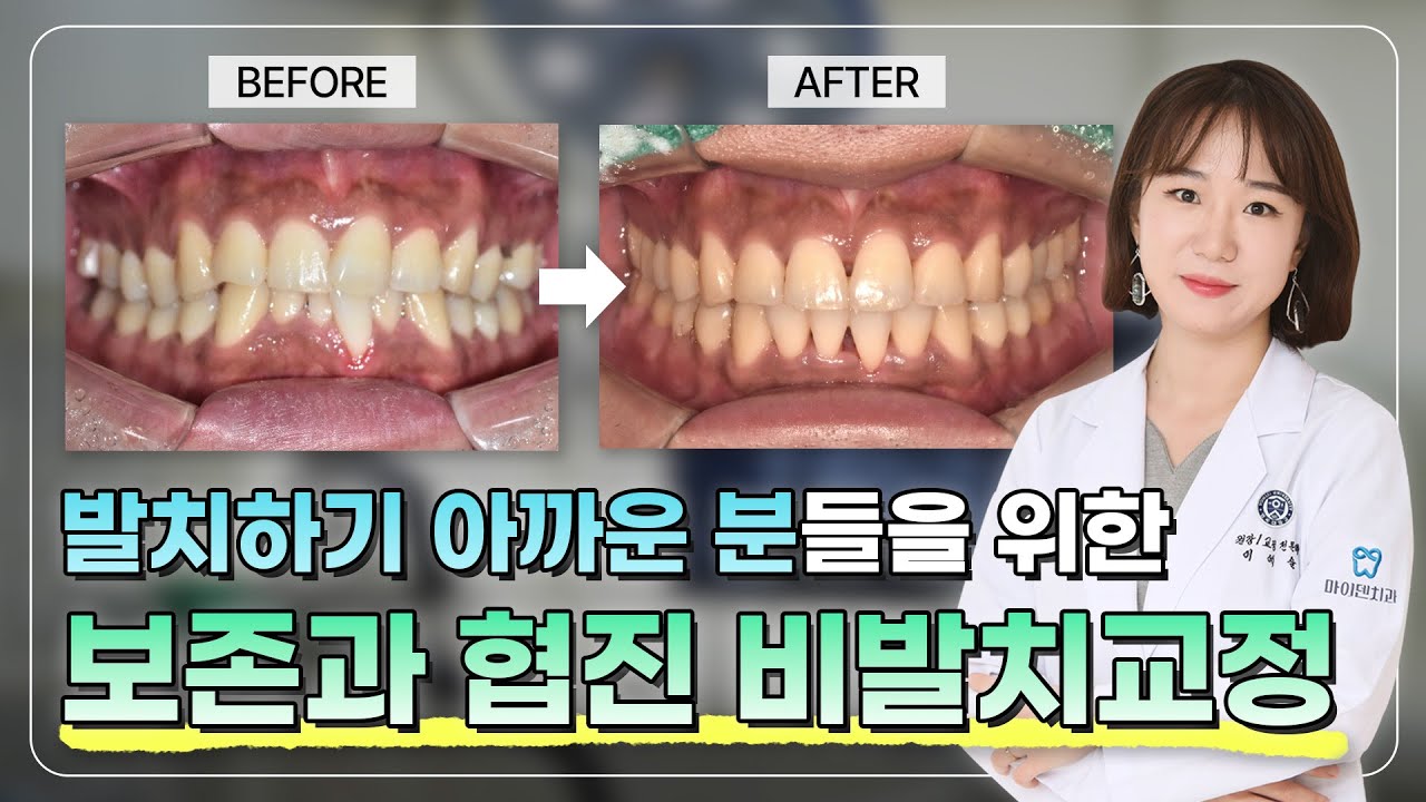 발치하기 아까운 분들을 위한 보존과 협진 비발치교정 케이스 - YouTube