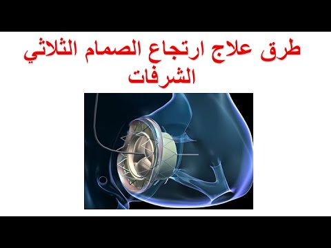 فيديو: هل كان عجز ثلاثي؟