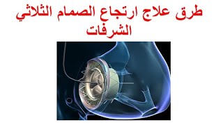 ما هي طرق علاج ارتجاع الصمام الثلاثي الشرفات ؟ اصلاح او استبدال الصمام الثلاثي جراحيا أو بالقسطرة