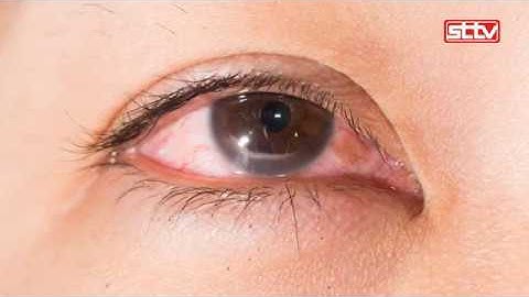 Sơ cứu đúng cách khi bị xước giác mạc | YTVN.VN