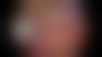 Laparoscopic right anterior sectionectomy