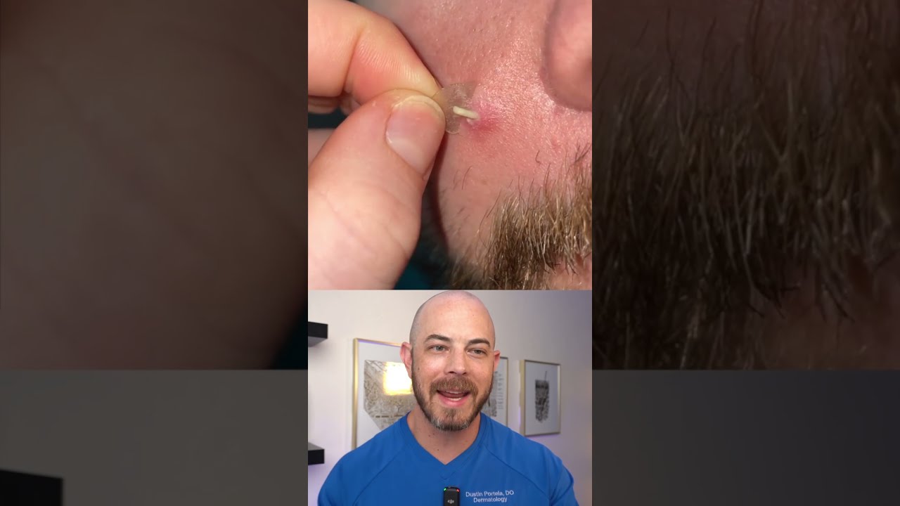 Doctor Reacts To Slimy Pimple Patch Removal Dermreacts Doctorreacts Pimplepop