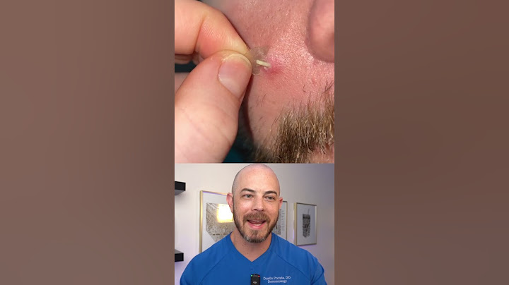 Doctor reacts to slimy pimple patch removal! #dermreacts #doctorreacts #pimplepop