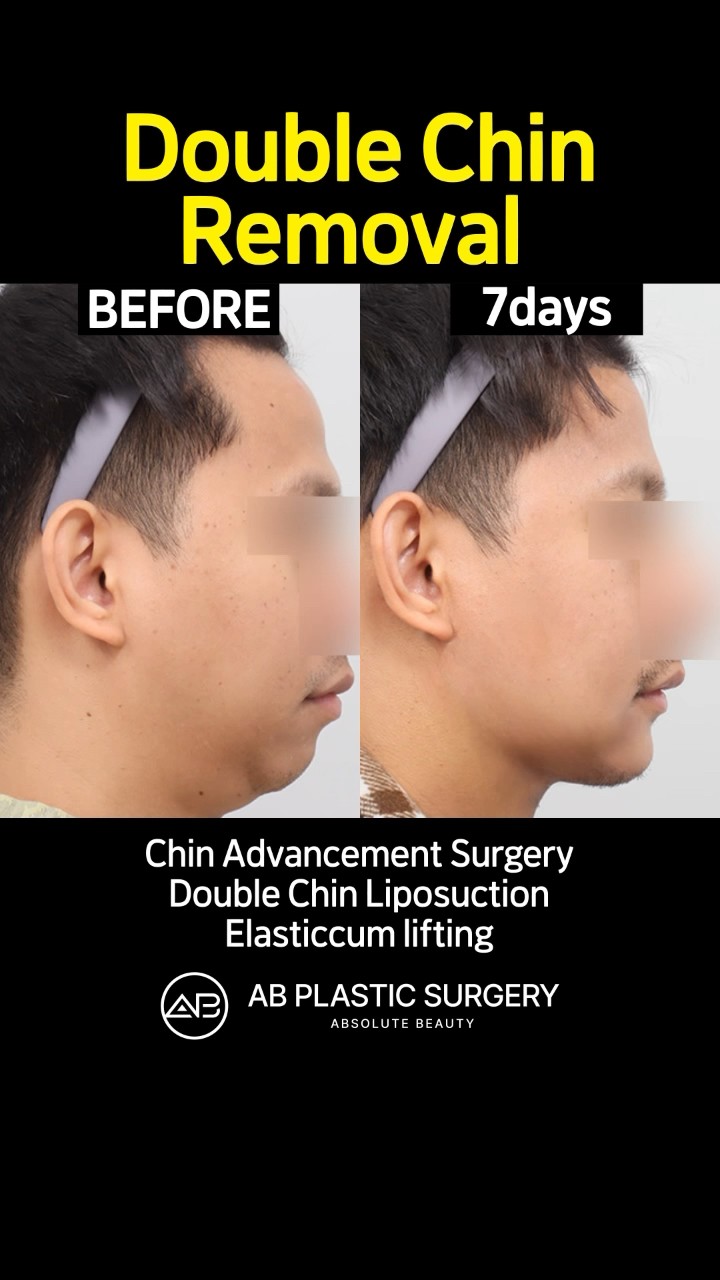 double chin removal #shorts