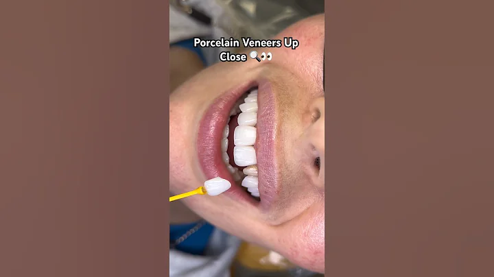 Porcelain Veneers up close ! 🔍👀 #veneers #dentalveneers #teeth #teeth #cosmeticdentistry #tryon