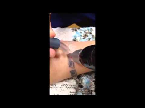 PicoSure Laser Tattoo Removal Dr. Kenneth Jesser - YouTube