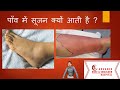 Ankle Swelling Leg Swelling In Hindi एडी की सूजन.पाँव  मे सूजन क्यों आती है?