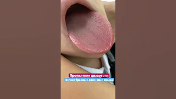 Дизартрия