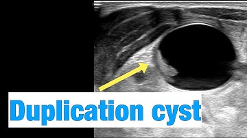 Duplication cyst I Ultrasound