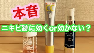 【本音】ニキビ跡の治し方を暴露します【効く？効かない？を商品名を出して語る】