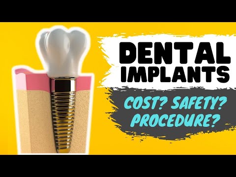 Dental Implant Procedure  DENTIST Reviews Implants Cost & Risks 