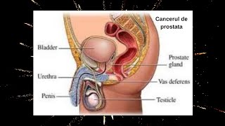 Afectează prostatita infertilitatea