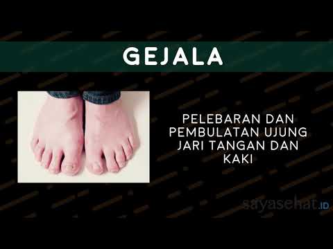 Video: Beban Keuangan Non-medis Dalam Perawatan TB: Survei Lintas Seksi Di Pedesaan Cina