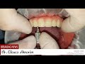 Instalação de Protocolo Superior e Inferior sobre Implantes dentário - Dr.Glauco Amorim.