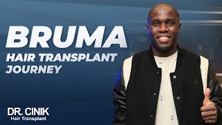 Bruma Hair Transplant Journey Dr Cinik Hair Hospital