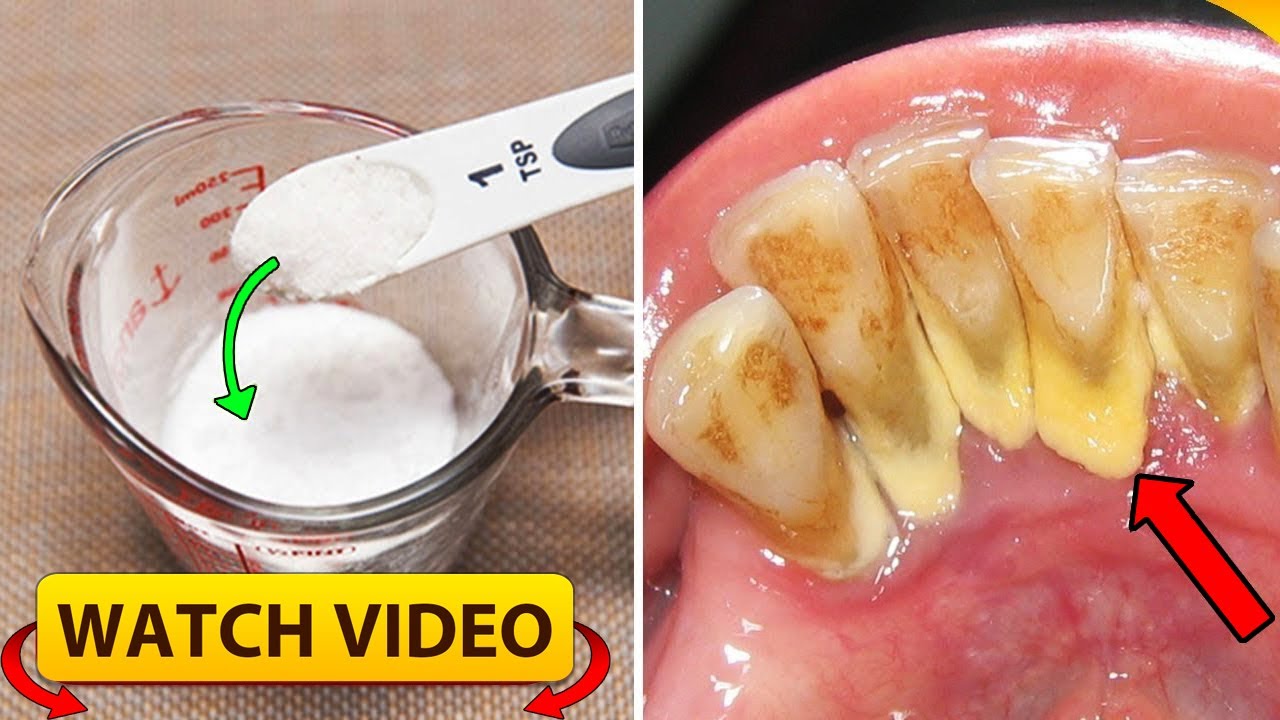 Mouthwash Removes Plaque From Teeth only In 2 Minutes YouTube