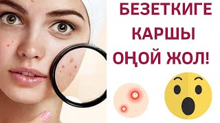 Бетке чыккан Безеткилерди (угри) кантип жок кылса болот?