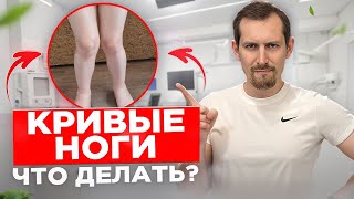 «Ноги иксом»: правильные шаги при вальгусной деформации!