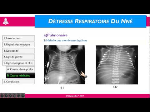 Vidéo: Tachypnée Transitoire Du Nouveau-né