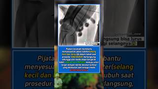Pijatan Bantu Kateter?