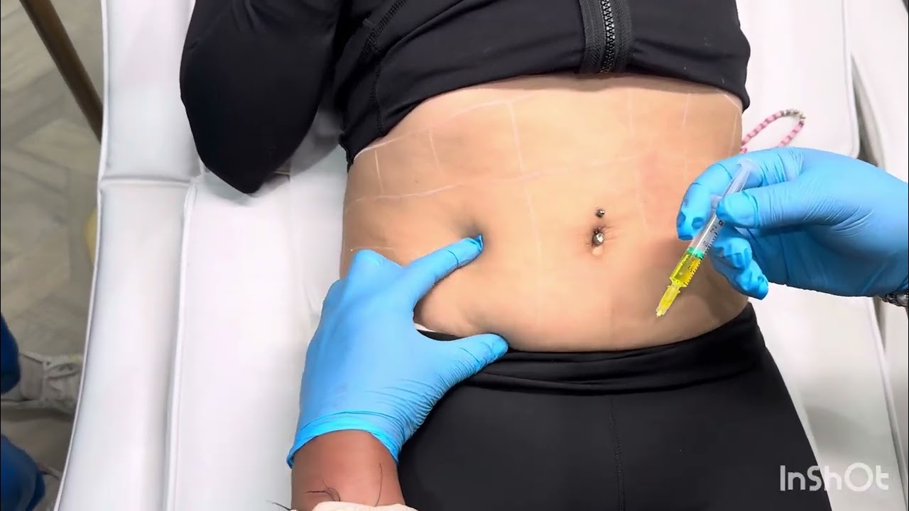 Lemon bottle Fat dissolving injections on belly. How to inject lemon bottle  on tummy. #lemonbottle