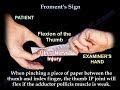 Froment's Sign - Everything You Need To Know - Dr. Nabil Ebraheim