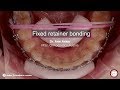 fixed permanent retainer bonding in orthodontics by dr. Amr asker