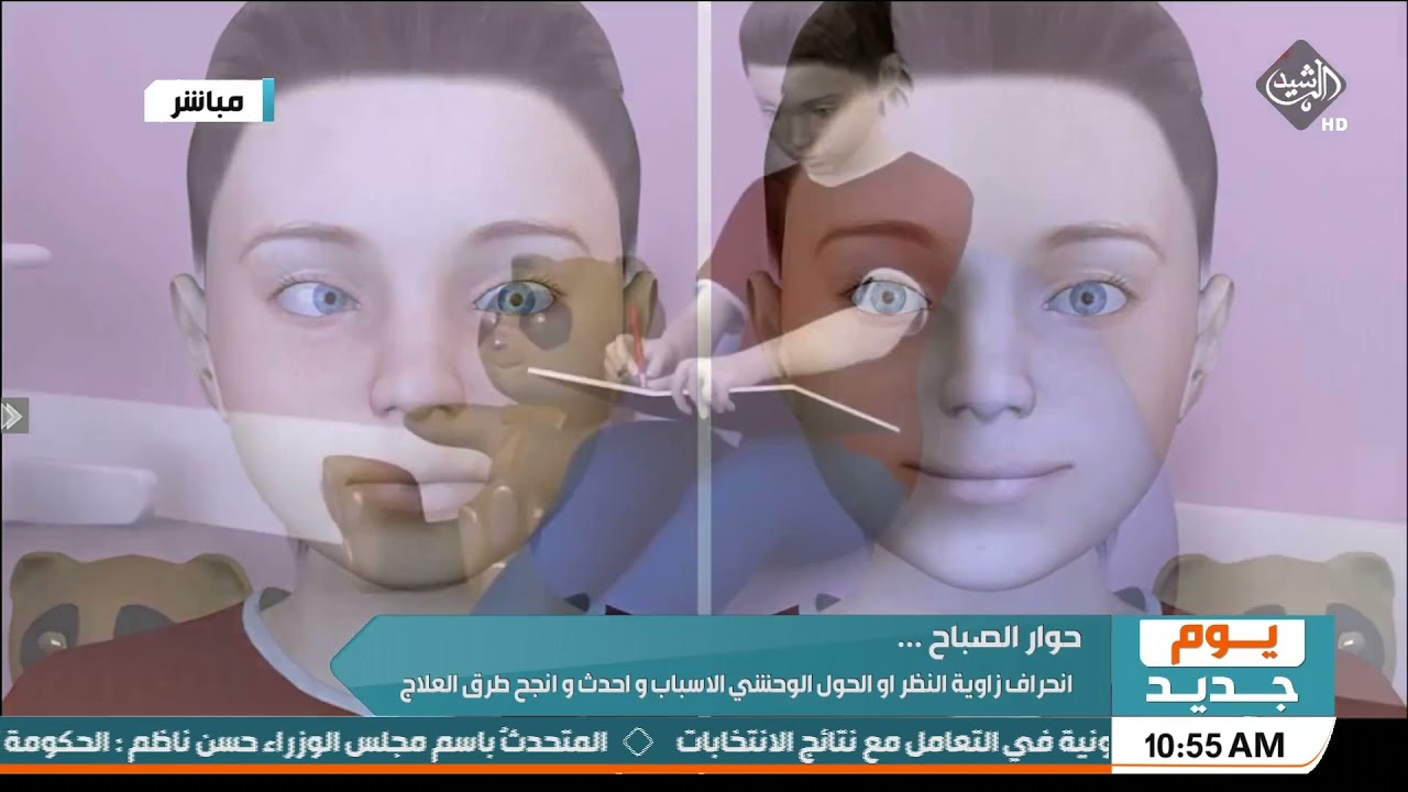 يوم جديد حوار الصباح الحول الوحشي او انحراف النظر .. الاسباب واحدث طرق العلاج