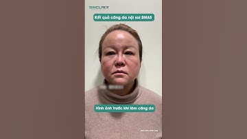 Kết quả căng da nội soi SMAS