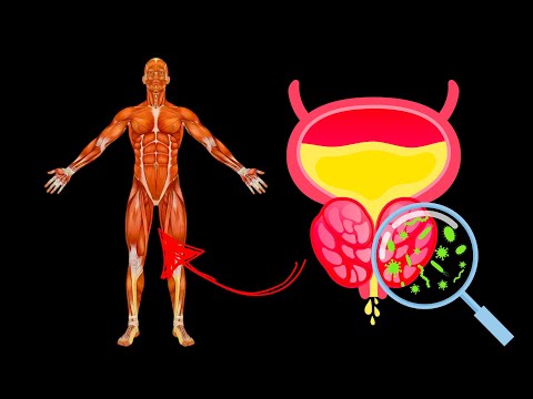 Video: Eesnäärme healoomuline hüperplaasia