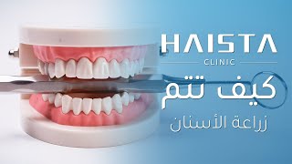 زراعة الأسنان | HAISTA CLINIC