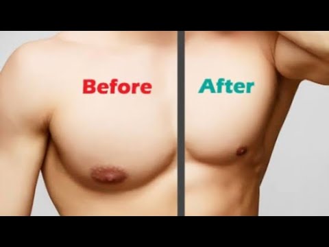 Gynecomastia/ male boobs/ Acupressure points / causes and treatment
