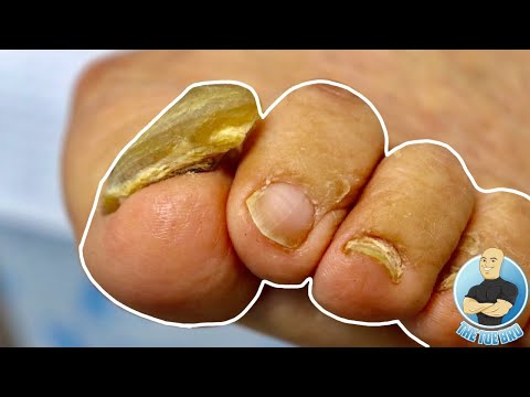 BIG THICK TOENAIL FINALLY GETS TRIMMED DOWN
