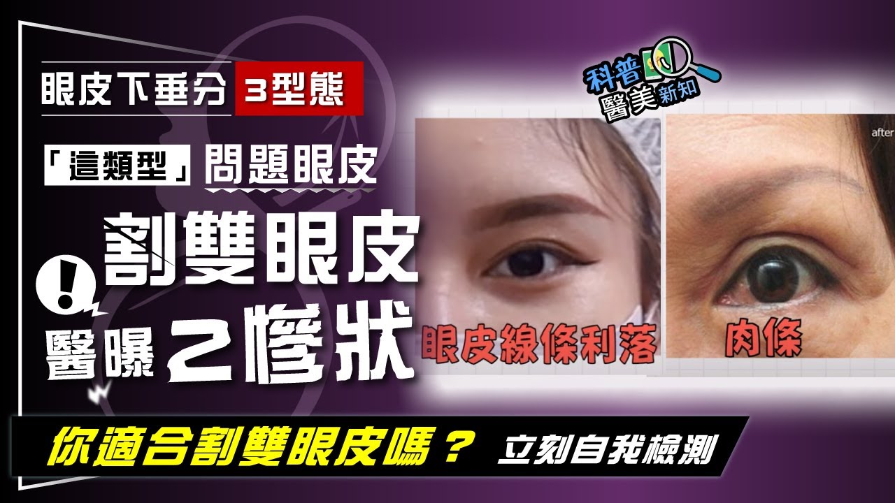 割雙眼皮前先搞懂這件事　下壓型/多皮型/無力型3大類眼皮下垂型態  你是哪一種？  全網史上最完整解析！科普醫美新知307-20230307