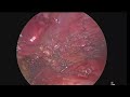 VATS Thymectomy for Myasthenia Gravis -  Extent of Resection - What and Why ?