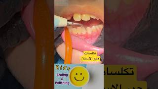 إزالة جير الأسنان #youtubeshorts #professional #dentist #trending #tiktok #dentist #care