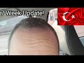 🇹🇷 Turkey Hair Transplant 7 Week Update