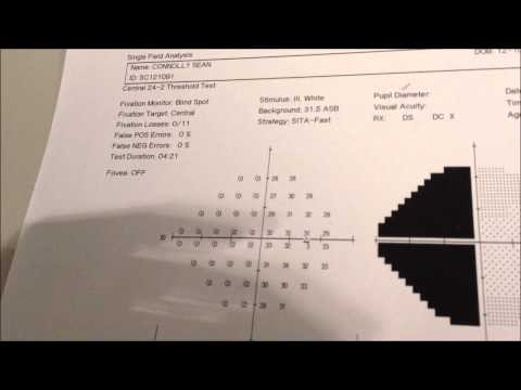 Visual Field Chart Interpretation