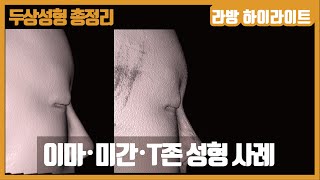 이마, 안와상융기 (미간, T존) 성형의 실사례 [두상성형 총정리 #2]