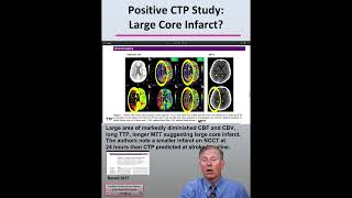CT Perfusion (CTP) Positive Imaging, Large Core Infarct, and Patient Mgmt: Acute Ischemic Stroke 31 Profile