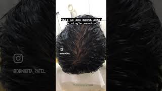 Platelet Rich Plasma (PRP) therapy for Hairloss| Dr. Nikita Patel, Dermatologist| Hair loss PRP